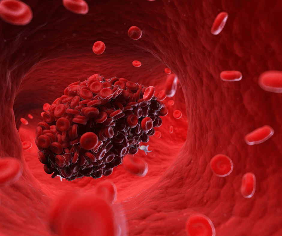 blood clot