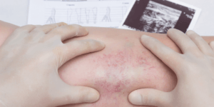 blood clot treatment