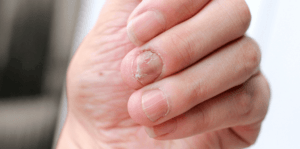nail fungus