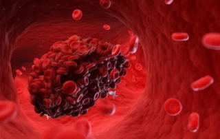blood clot