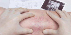 blood clot treatment