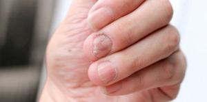 nail fungus